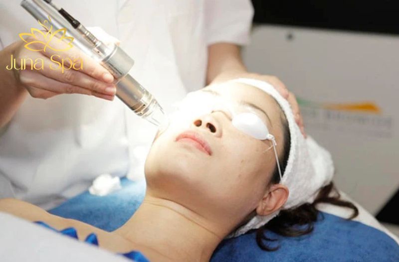 Trị tàn nhang bằng công nghệ Laser CO2 Fractional Julab Melasma