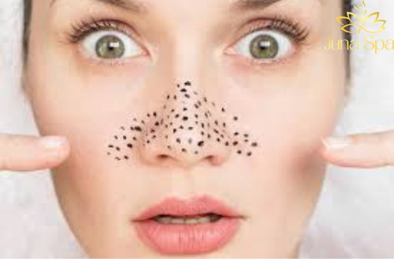 Lỗ chân lông to rõ hơn sau Tết: Nguyên nhân và cách cải thiện bề mặt da