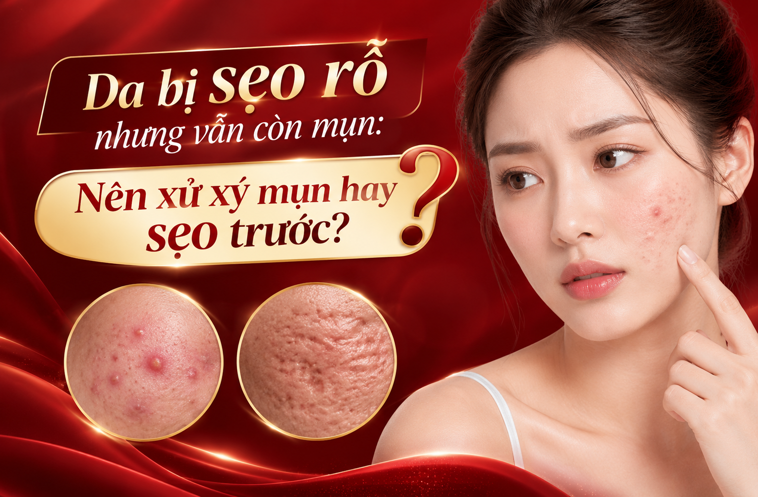 Da bị sẹo rỗ nhưng vẫn còn mụn: Nên xử xý mụn hay sẹo trước?