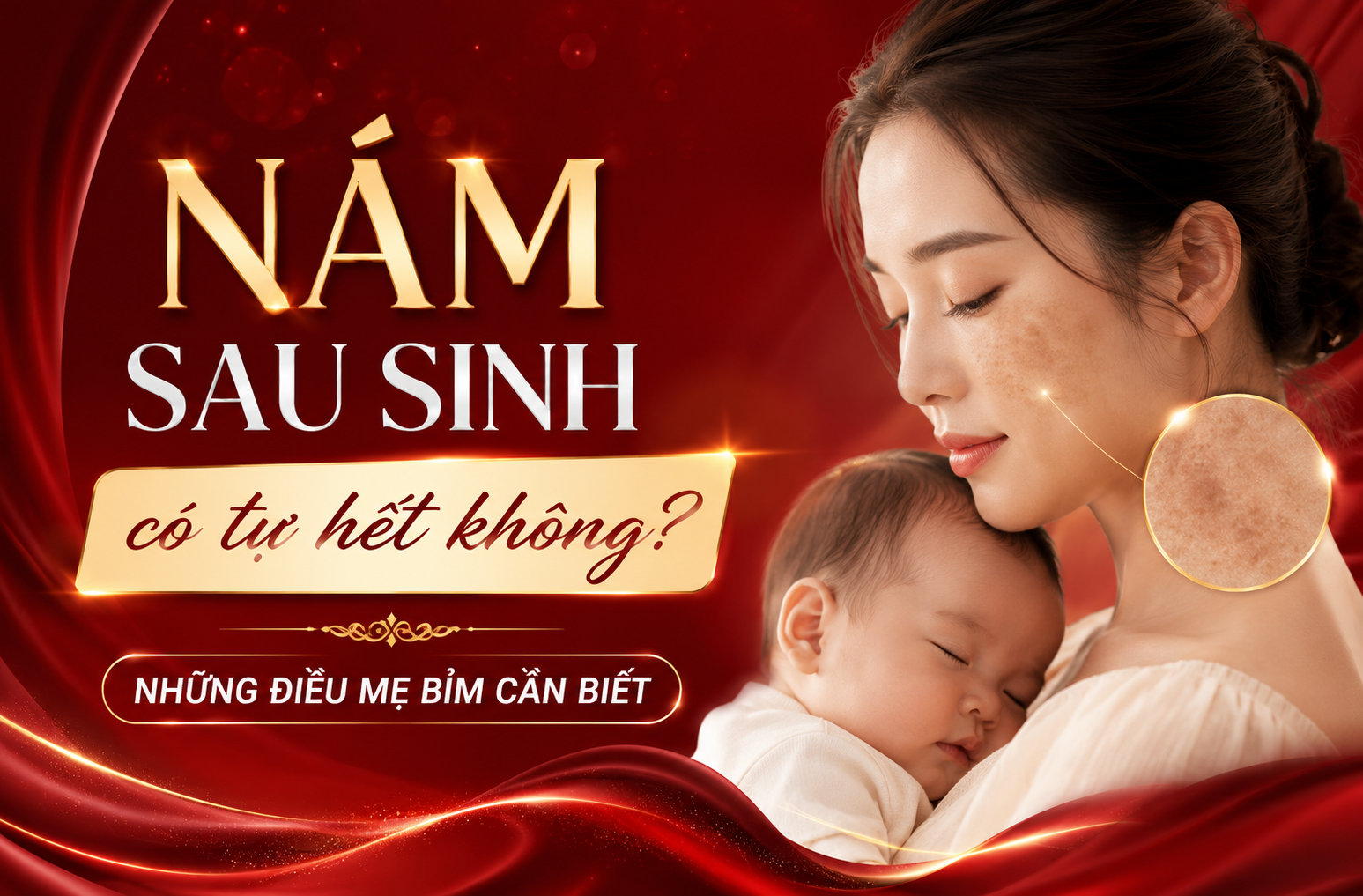 Nám sau sinh có tự hết không? Những điều mẹ bỉm cần biết