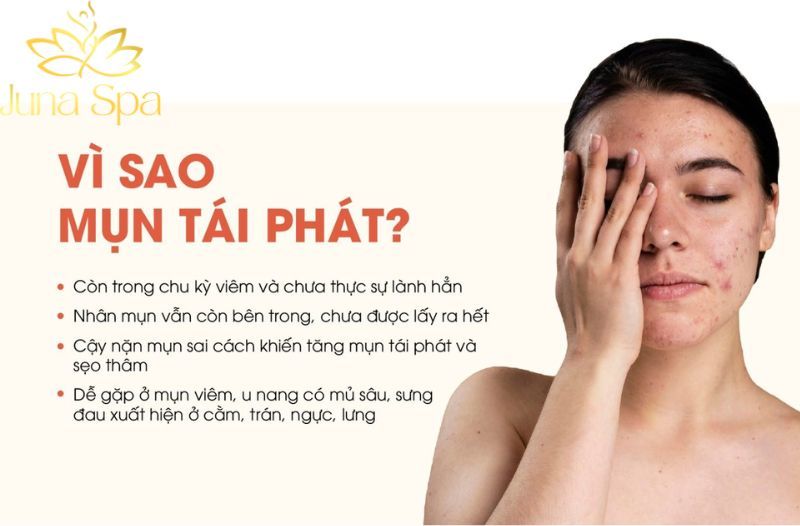 Vì sao người Việt dễ nổi mụn và mụn tái phát dai dẳng?