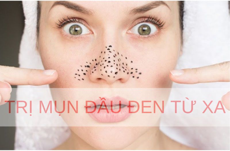 TRỊ MỤN ĐẦU ĐEN TỪ XA