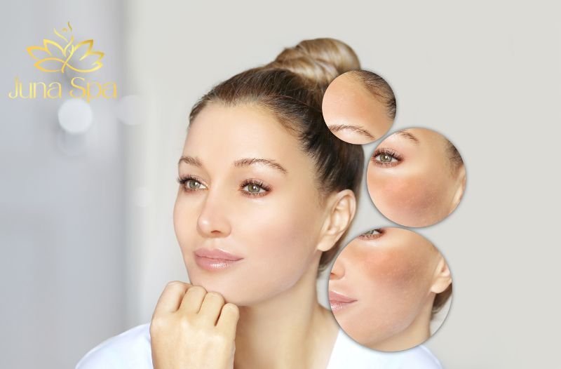duy trì kết quả điều trị nám