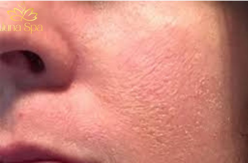 Cách khắc phục da sần vỏ cam giúp chị em tự tin diện đồ đẹp
