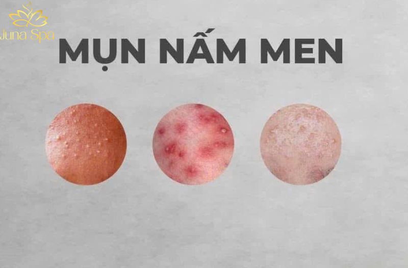 mụn nấm men