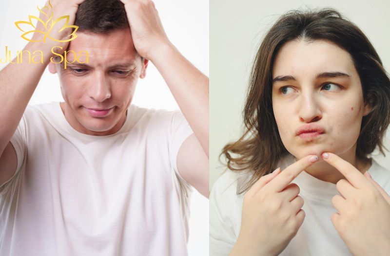 mụn viêm và stress