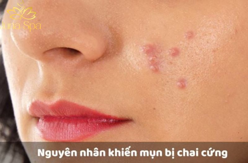 Mụn chai: Nguyên nhân, dấu hiệu và cách xử lý đúng cách