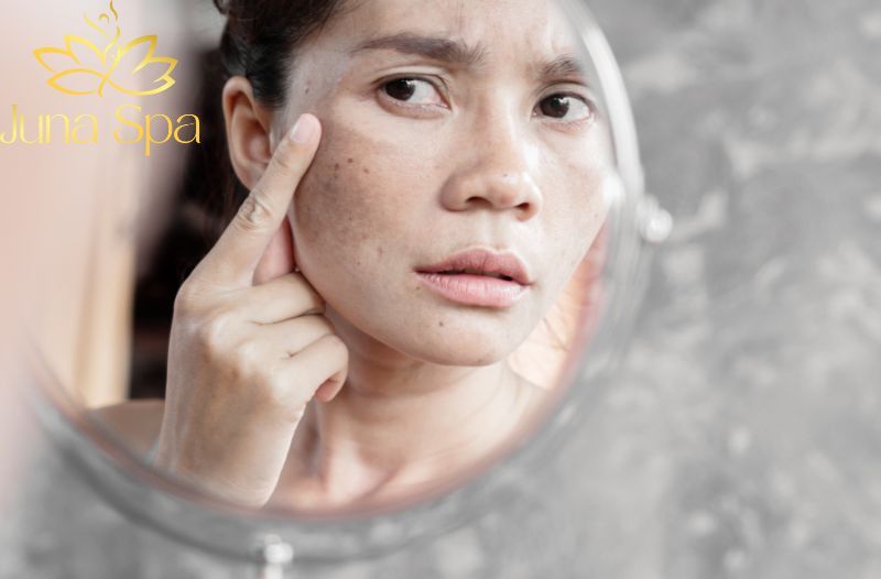 Những sai lầm khiến nám tái phát sau khi bắn Laser CO₂ Fractional Julab Melasma và cách phòng tránh