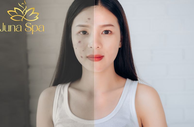 Mụn ẩn lâu năm