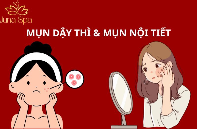 Mụn dậy thì và mụn nội tiết tố khác nhau như thế nào? Cách chăm sóc da khi xuất hiện mụn
