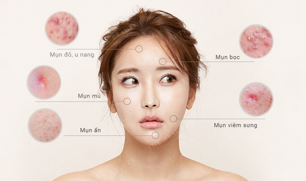 6 loại mụn thường gặp
