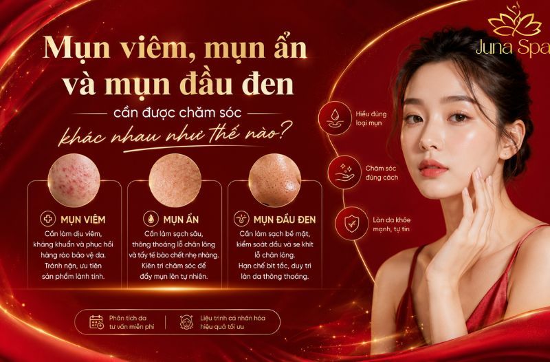 Mụn viêm, mụn ẩn và mụn đầu đen cần được chăm sóc khác nhau như thế nào?