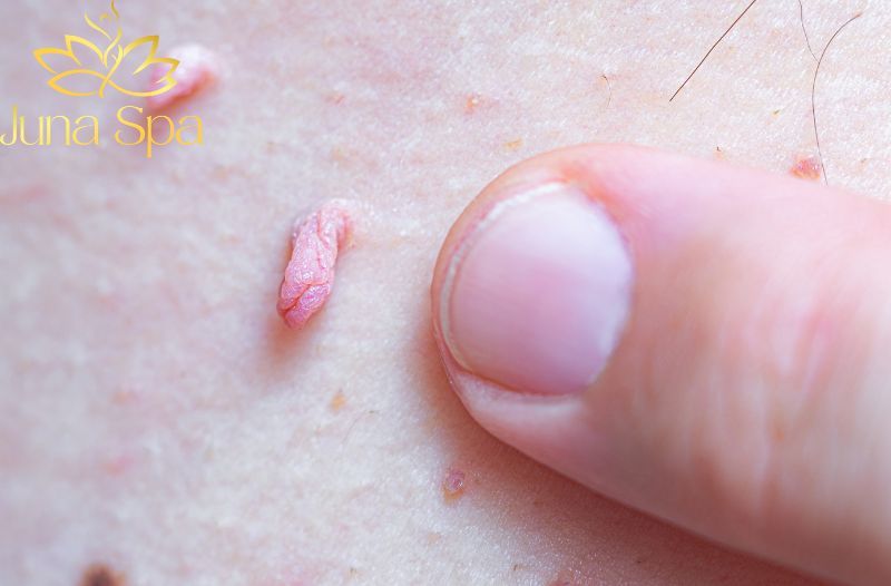 5 tác nhân gây mụn cóc mà bạn cần tránh