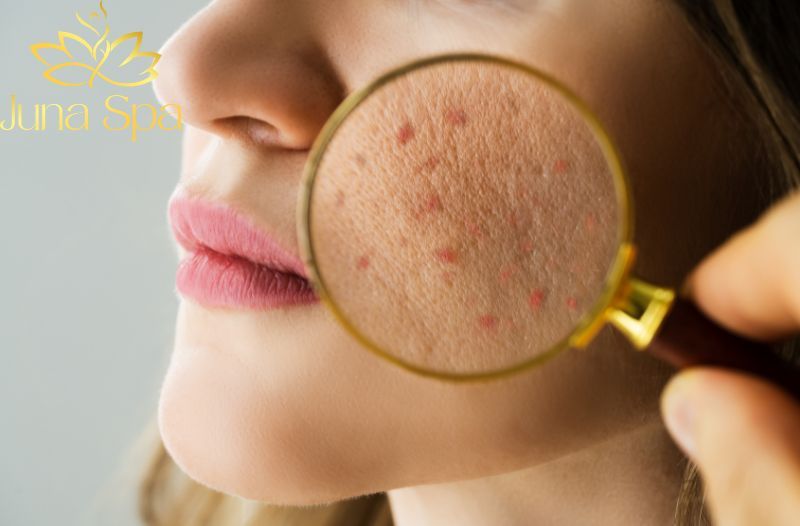 Nguy cơ khôn lường khi dùng Corticoid khi trị mụn