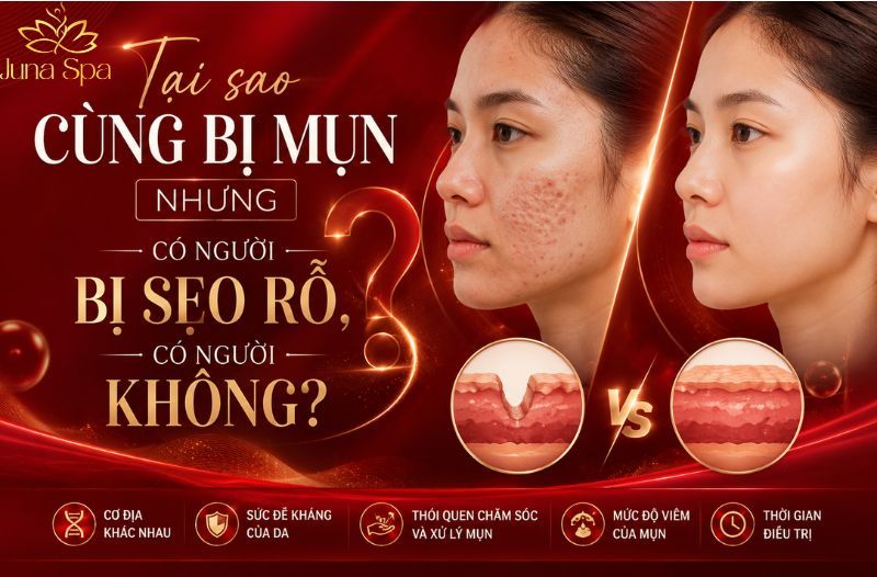 Tại sao cùng bị mụn nhưng có người bị sẹo rỗ, có người không?