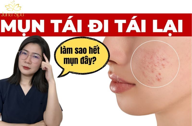 Mụn tái đi tái lại cùng một vị trí: Lý do nằm ở đâu?