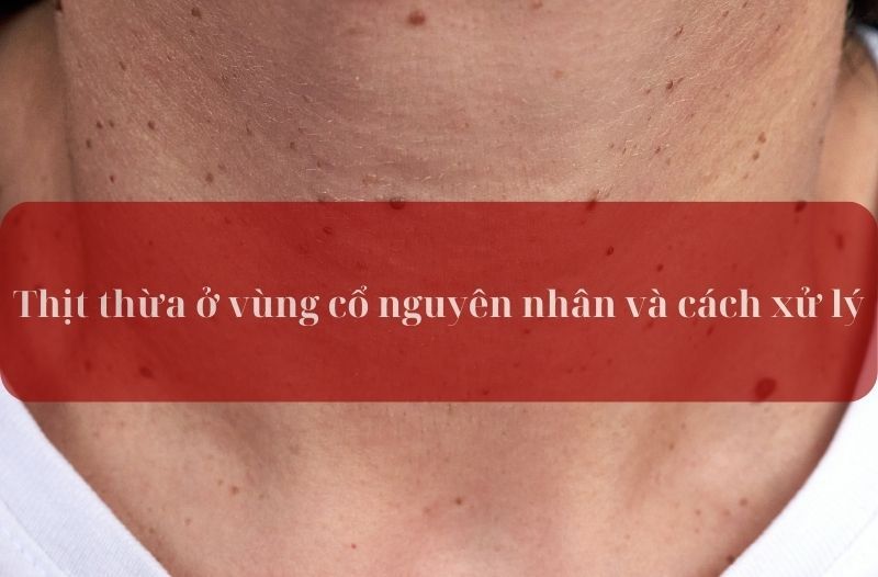 Mụn thịt thừa ở vùng cổ nguyên nhân và cách xử lý