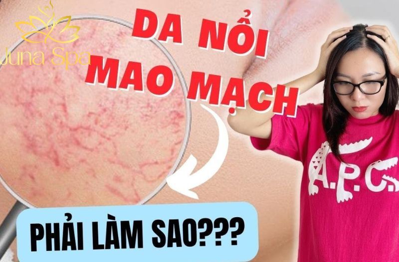 da nổi mao mạch