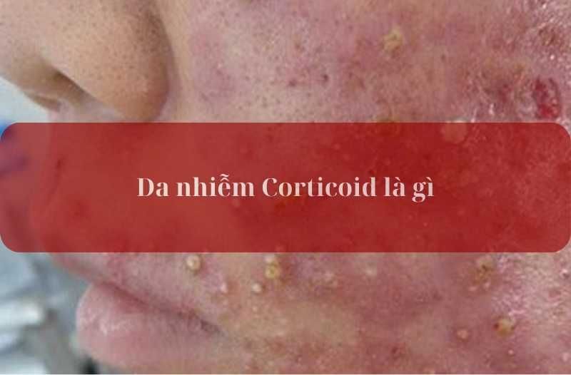 da nhiễm corticoid là gì