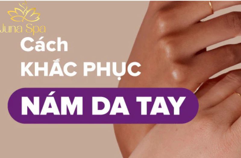 Nám da tay vào mùa nắng nóng là gì và cách chăm sóc để da đều màu hơn
