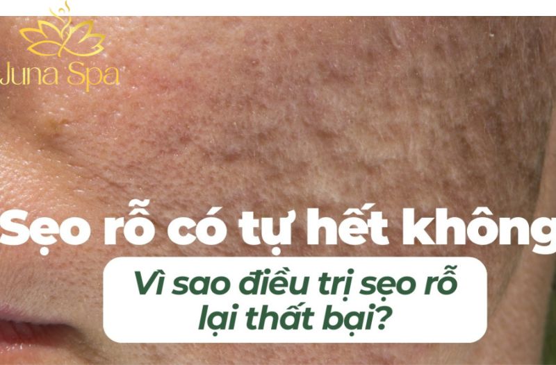 Sẹo rỗ là gì và vì sao khó cải thiện triệt để?