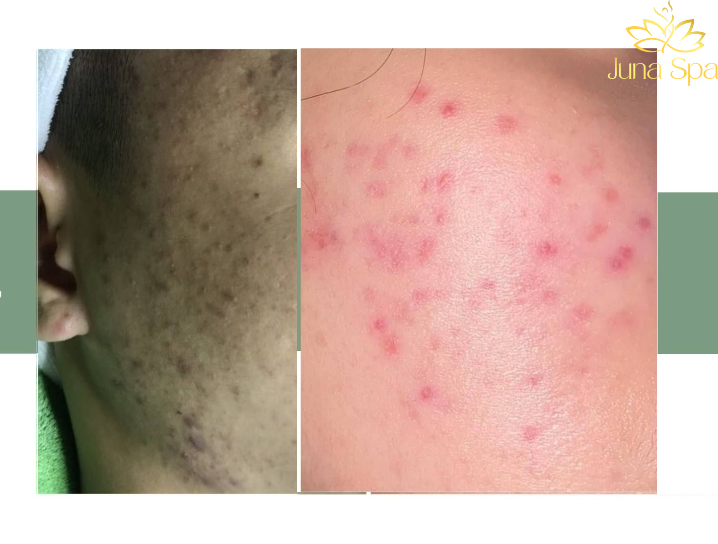 Phân biệt nám và thâm sau mụn qua vị trí xuất hiện