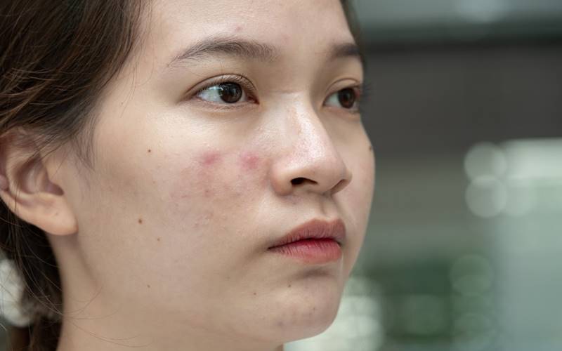Vai trò của nấm Malassezia và sự tăng tiết bã nhờn