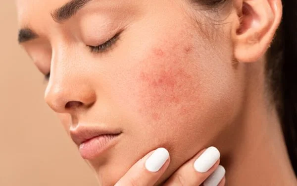 Dấu hiệu điển hình: đỏ da, vảy nhờn, ngứa