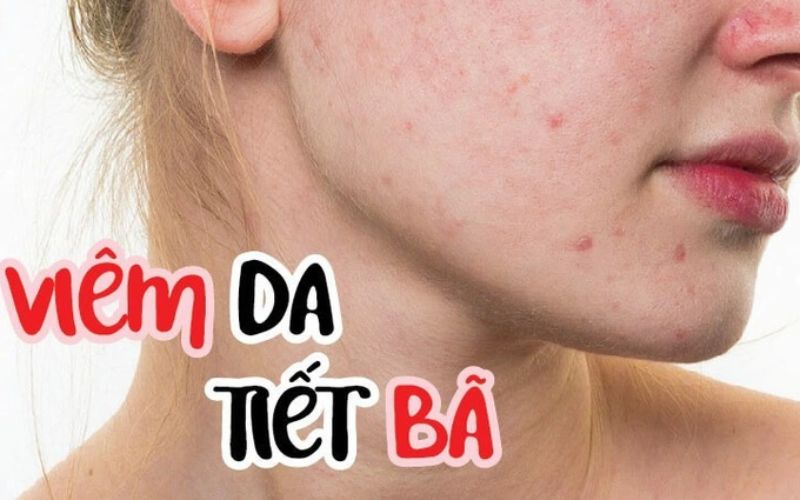viêm da tiết bã ở mặt