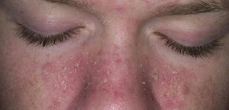 Phân biệt với các bệnh da mặt khác (vảy nến, rosacea, chàm)