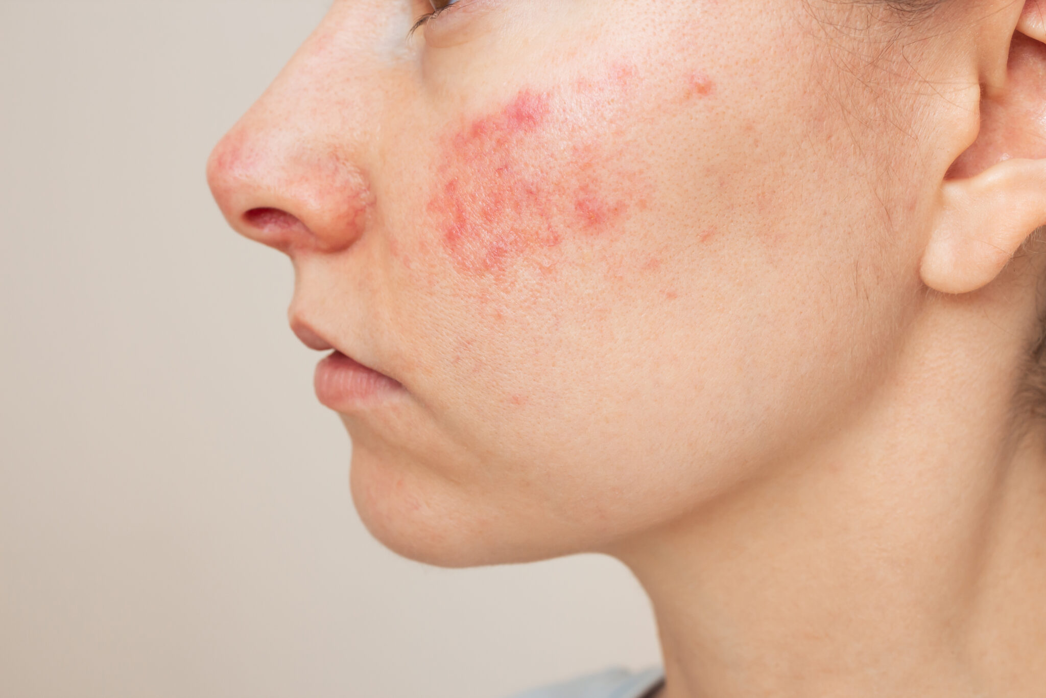 Phân biệt với các bệnh da mặt khác (vảy nến, rosacea, chàm)