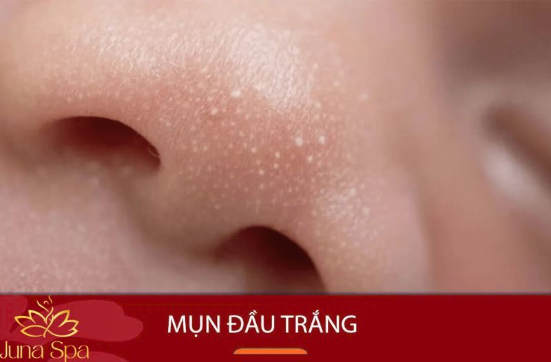 Vì sao lại xuất hiện mụn đầu trắng?