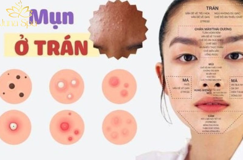 Mụn ẩn vùng trán: Vì sao càng skincare càng nổi nhiều hơn?