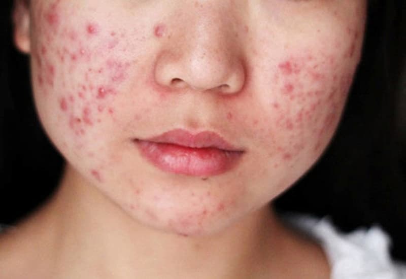 trị mụn trứng cá là gì