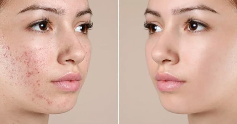 các bước trong quá trình trị mụn trứng cá