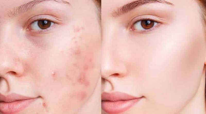 trị mụn trứng cá