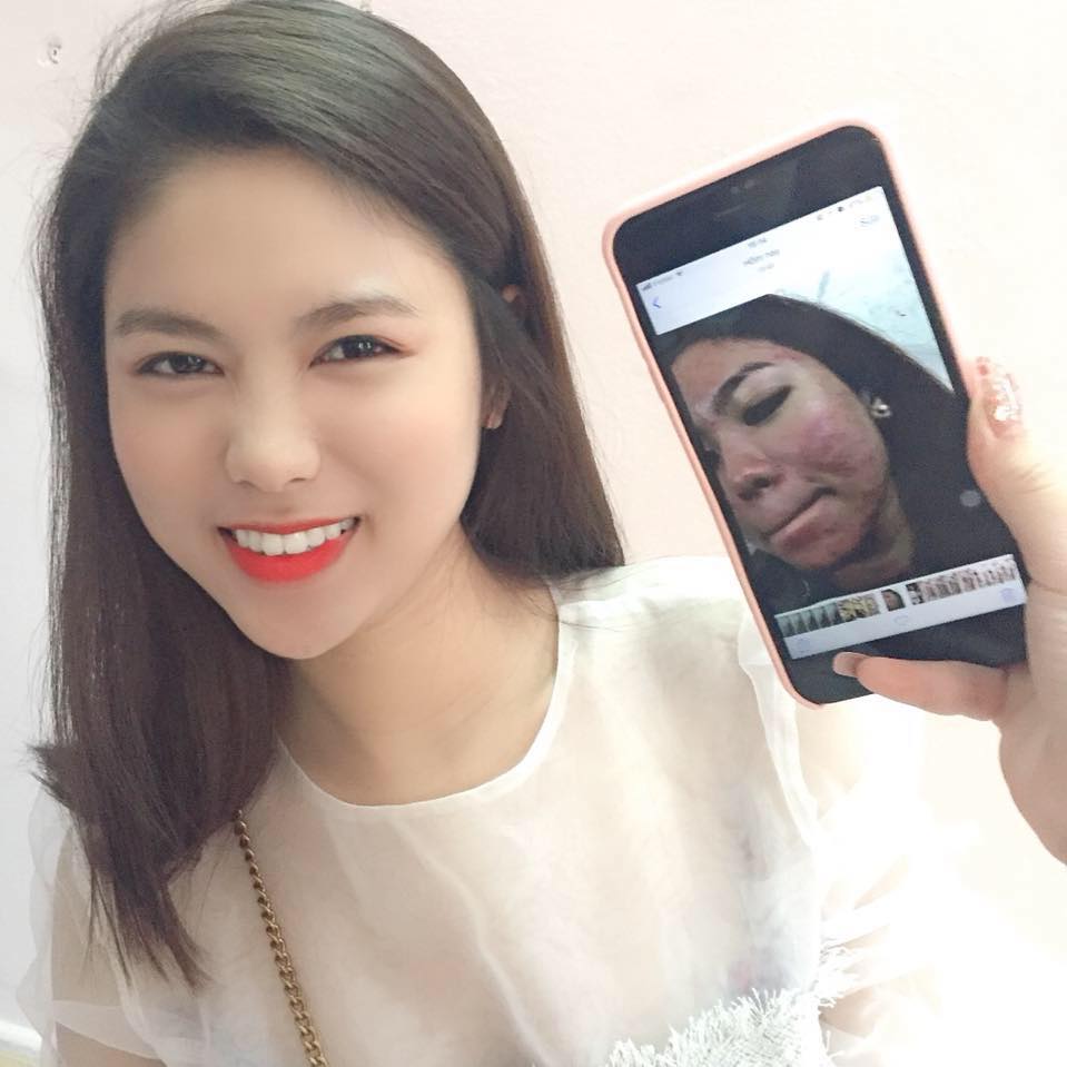 tri mụn từ xa