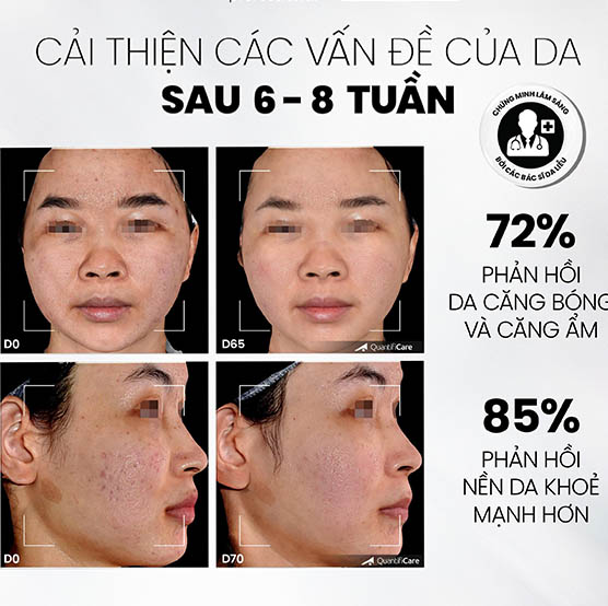 LÂM sàn mdcare glow exfo
