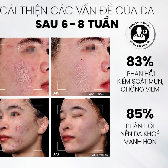 MDCare AntiAC Exfo cải thiện các vấn đề về da