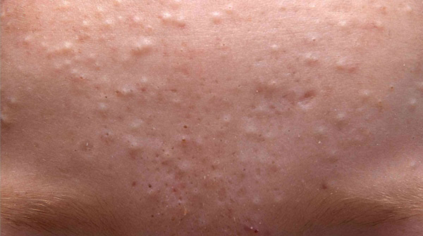 mụn đầu trắng là gì
