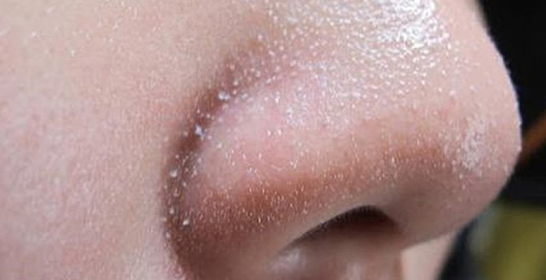 nguyên nhân mụn đầu trắng