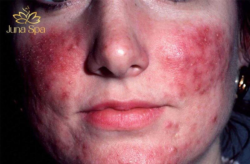 da nhiễm corticoid đỏ