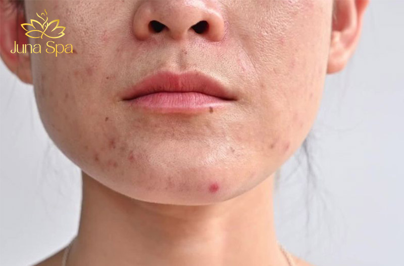 da nhiễm corticoid là gì