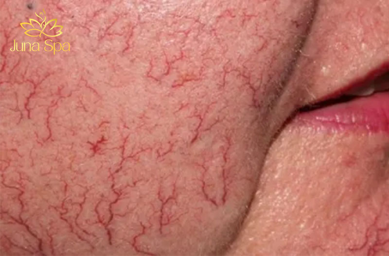 da nhiễm corticoid nặng