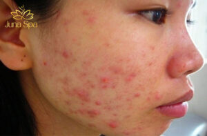 da nhiễm corticoid nhẹ