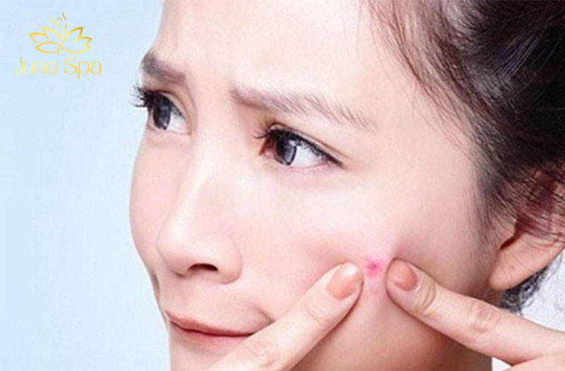 tự ý nặn mụn