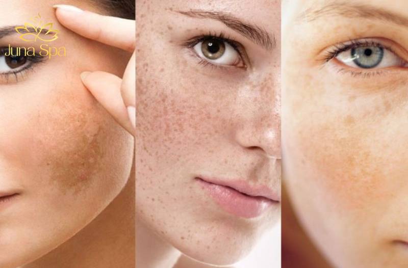 nám da hỗn hợp
