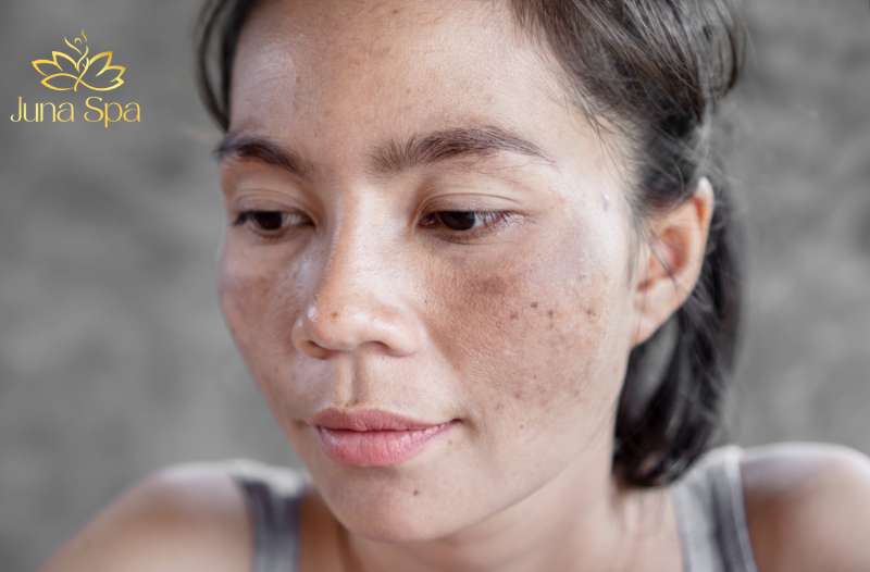 nám da thời kỳ mãn kinh là gì
