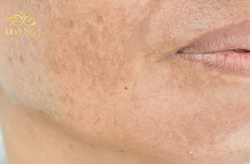 TRỊ NÁM TẠI JUNA SPA