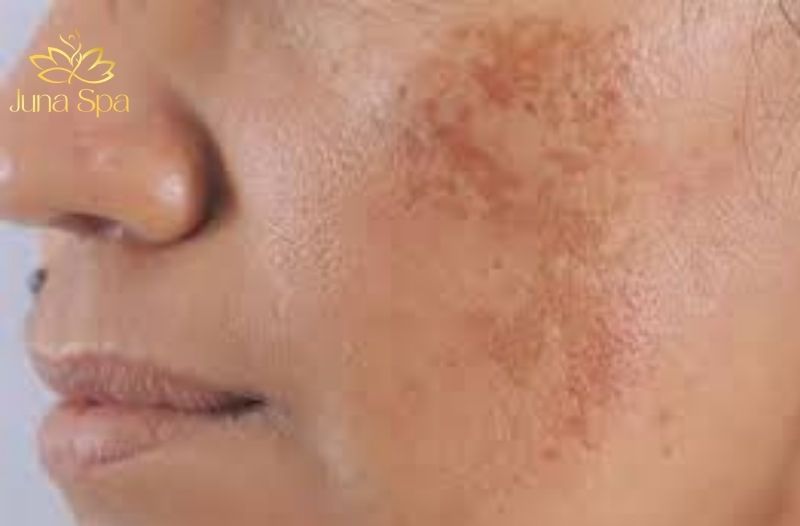 nám ở nam giới do di truyền